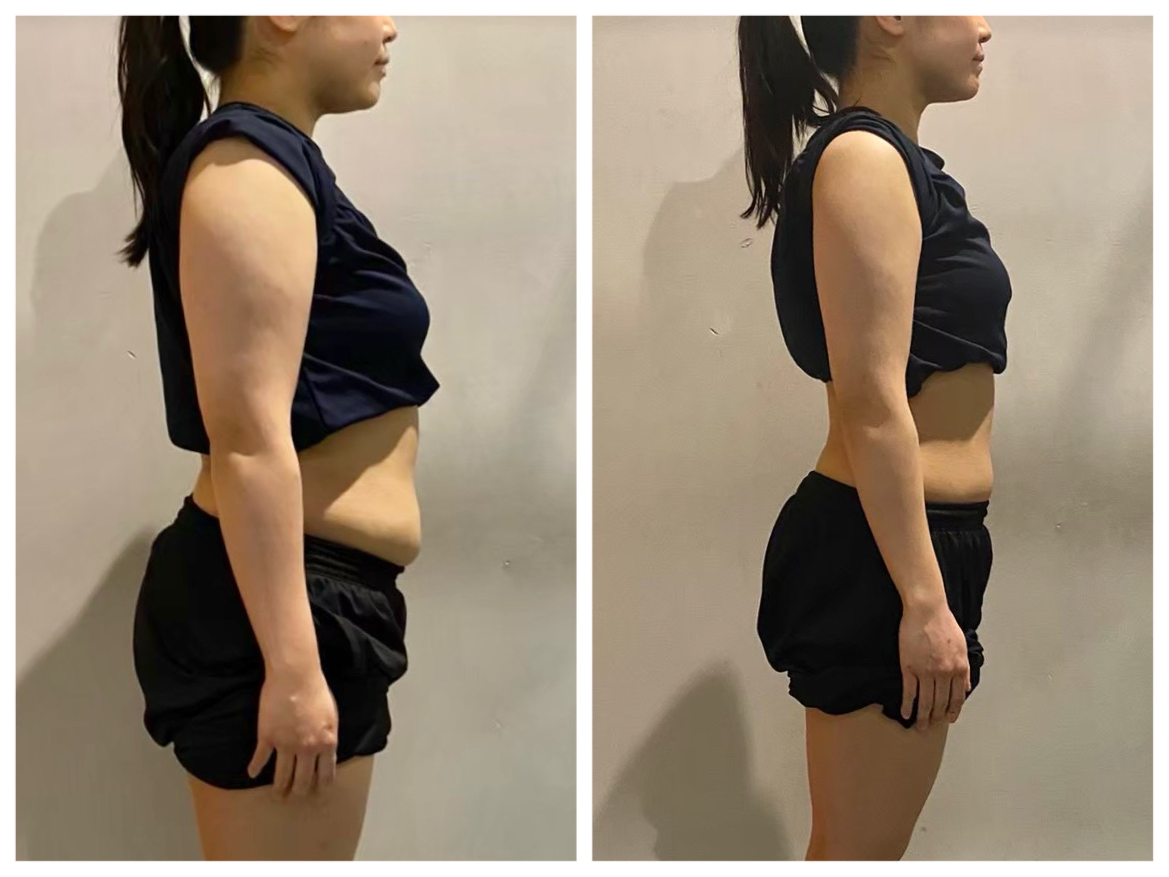 I様のダイエット開始前と2ヶ月後の横姿を比較した写真